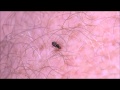 Black fly feeding