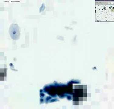 Histopathology Cervix--HSIL
