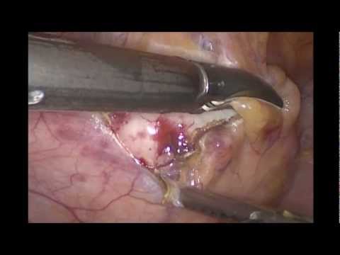 Space of Retzius Neoplasm