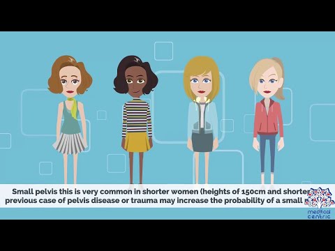 CEPHALOPELVIC DISPROPORTION (CPD), Causes, Signs and Symptoms, Diagnosis and Treatment.