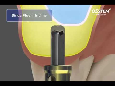 Crestal Approach Sinus Kit (CAS Kit) - Sinus List made easy by OSSTEM HIOSSEN.mp4