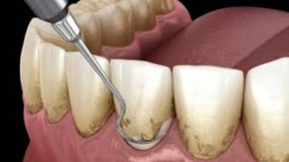 Raspado y alisado radicular.