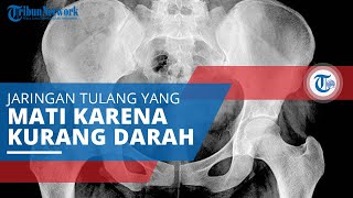 Avascular Necrosis, Kondisi Jaringan Tulang Mati karena Kurang Pasokan Darah Sebabkan Tulang Hancur