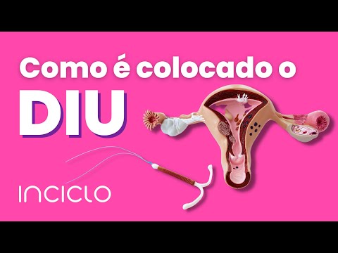 How the IUD is Inserted - How IUD Insertion Works