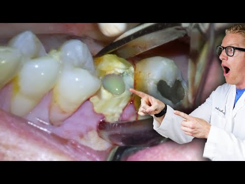 Badly Infected Tooth Extraction Procedure With Pus Coming Out of The Tooth