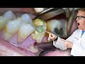 Badly Infected Tooth Extraction Procedure With Pus Coming Out of The Tooth!