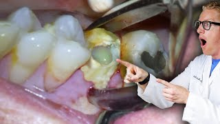 Badly Infected Tooth Extraction Procedure With Pus Coming Out of The Tooth!
