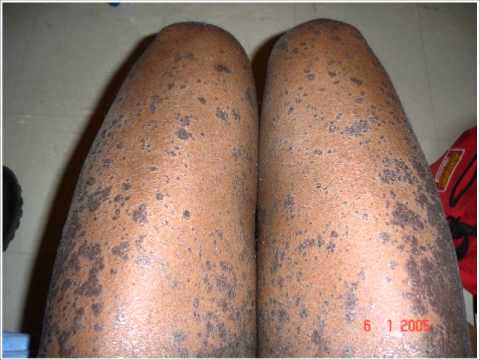 comment soigner psoriasis mains