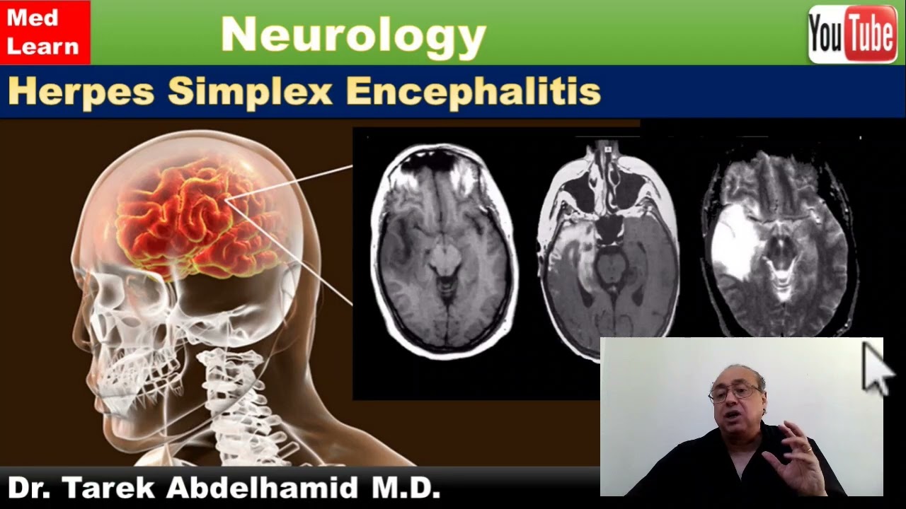 Herpes Simplex Encephalitis (HSE)