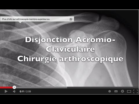 comment soigner entorse acromio claviculaire