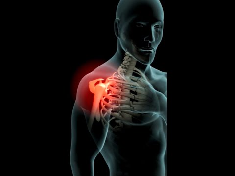Shoulder pain (rotator cuff tear) and surgical repair #science #anatomy #shorts