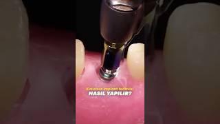 İMPLANT TEDAVİSİNİN EN İYİ YOLU !