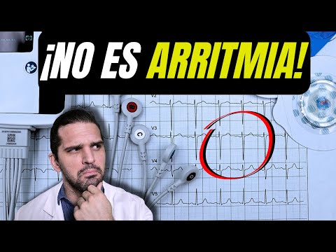 Not every palpitation is an arrhythmia | A real case with a Holter monitor 😲