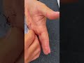 How To Remove A Hook Deep In The Hand Shorts