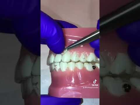 Using rubber bands with Invisalign aligners