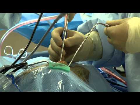Doctors Perform Brain Surgery...Through the Nose!