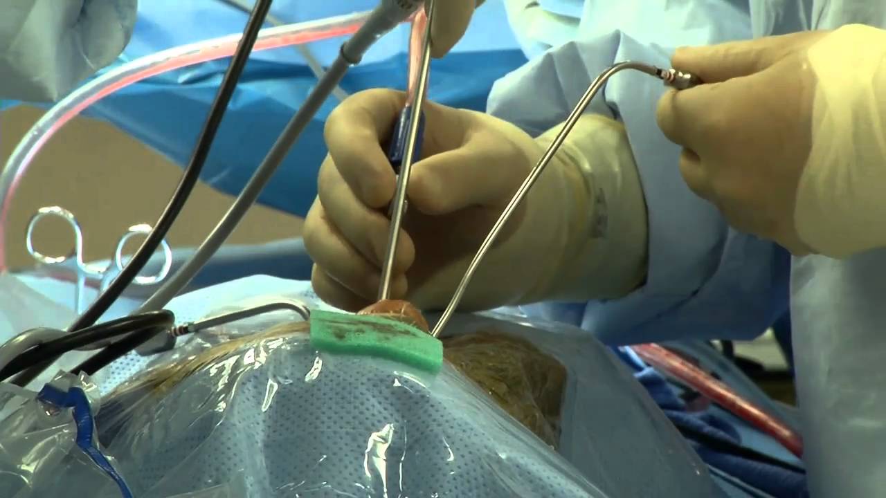 Doctors Perform Brain Surgery...Through the Nose!