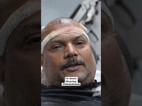 CID Actor Daya Hair Transplant Result #celebrityhairtransplant #hair #bollywood #viral