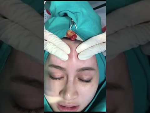 หน้าอกในวันที่ 3 หลังจาก mammoplasty พลาสติกบนหน้าอกหย่อนคล้อย