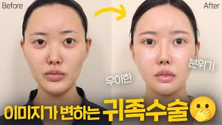 우아한 분위기! 이미지가 변하는 귀족수술!! #코성형 #강남성형외과 #plasticsurgery