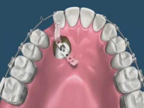 Yoga divulgazione delle articolazioni dellanca Fluido nel articolazione dellanca in un bambino a causa dellinfluenza