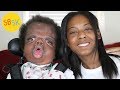 King S Tale Living With Beare Stevenson Syndrome