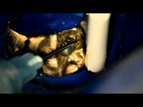 Use of Gates Glidden (GG) Burs in Root Canal Preparation