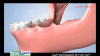 IZGUBLJENI ZUB NARUŠAVA LEPOTU, ALI I ZDRAVLJE