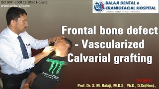 Frontal bone defect   Vascularized Calvarial grafting