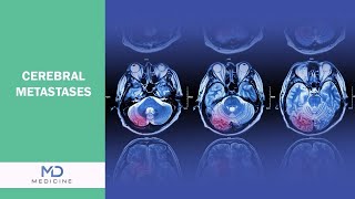 Understanding Cerebral Metastases: Symptoms, Causes, and Treatment Options - @mdmedicine.network