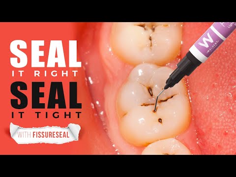 Seal it Right, Seal it Tight with FissureSeal #dental #dentistry #waldent #dentalkart #dentalcare