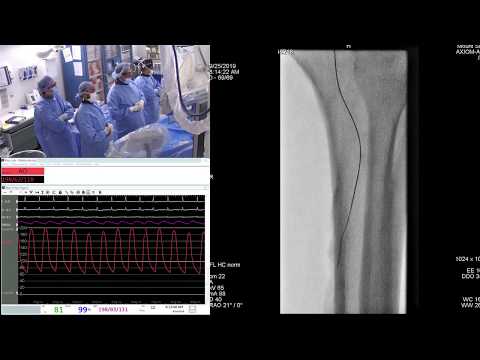 Popliteal Artery CTO Intervention for severe intermittent claudication and rest pain.