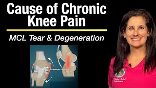 MCL tears and degeneration is a common cause of chronic knee pain- Motion ultrasound helps diagnose