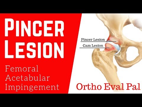 Superior Gluteal Artery Occlusion Mimick Herniated Disc