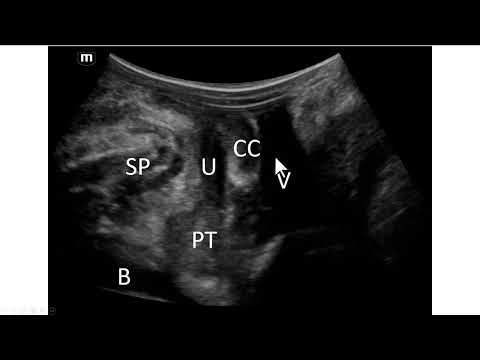 Remanescente de corpo cavernoso após cirurgia de redesignização sexual. Achados na ultrassonografia