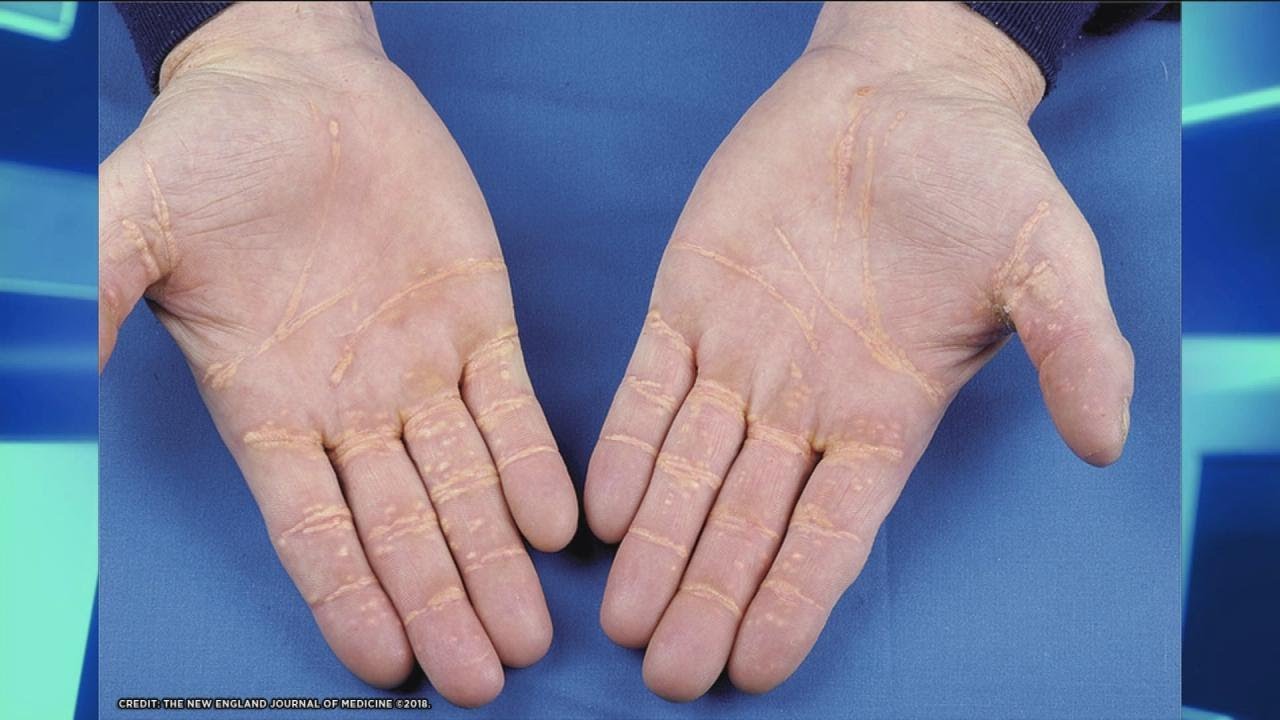 Xanthoma – Could it Happen to You? - YouTube
