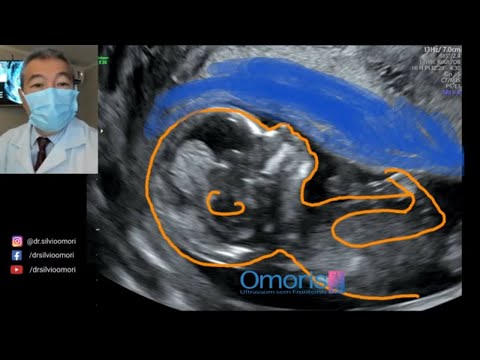 , title : 'How does a 13 week pregnancy look on an ultrasound?'