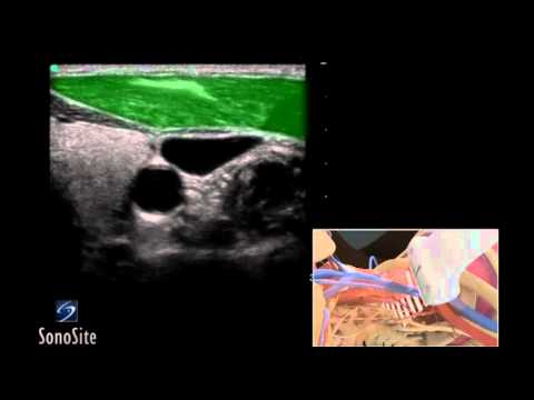 How To: Ultrasound Guided Insertion Internal Jugular Catheter (Long) 3D Video