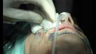 הזרקת שומן להצערת פנים