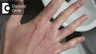 Causes of black spots, cuts & itching on fingers-Dr. Aruna Prasad