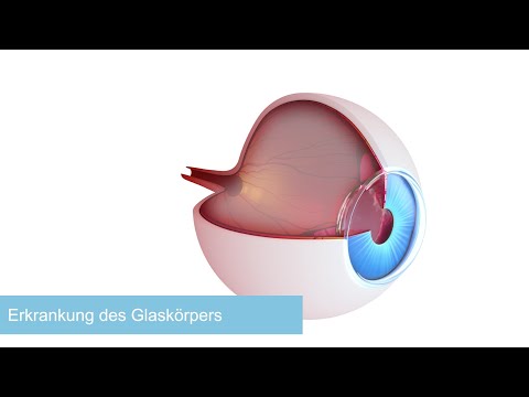 Glaskörpererkrankungen: Ursache, Symptome, Diagnose und Therapie in 3 Minuten von augenchirurgie.org