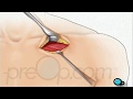 Permanent Pacemaker Implant Surgery  • PreOp® Patient Education ❤