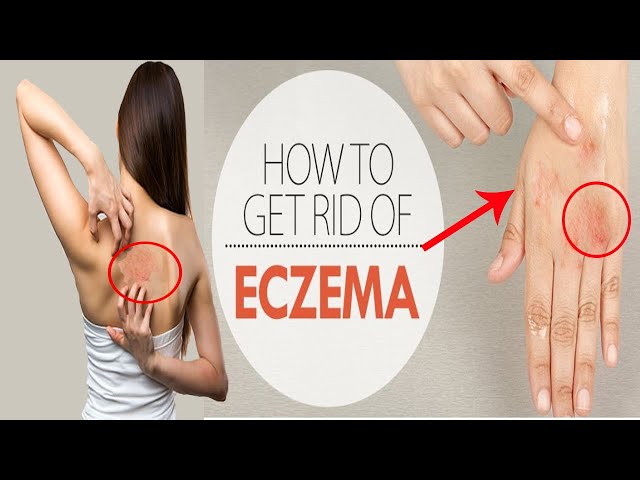 Video Pronunciation of eczematous in English Video Pronunciation of eczematous in English