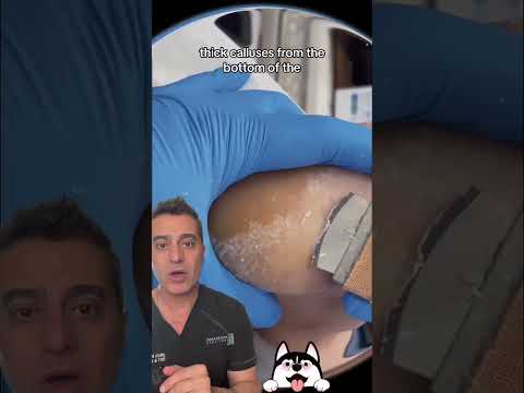 You won't believe the results of this satisfying foot skin cleanup