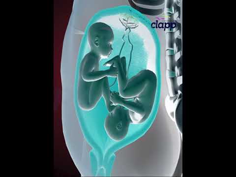 Twins struggles inside the Womb for supremacy (3D Animation)