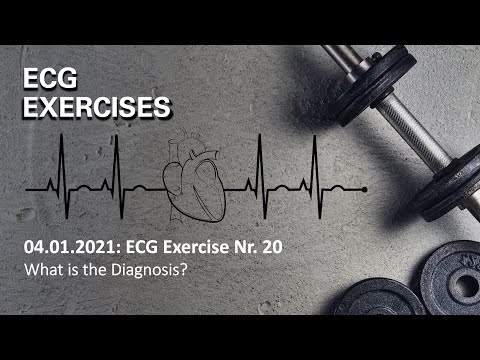 ECG Exercise Nr.20: A young man with wide QRS complex tachycardia