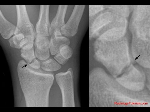 TeleHealth: Scaphoid Fracture