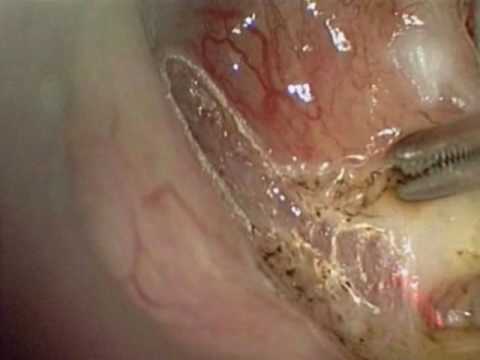 Laser assisted cordectomy with MCO 25plus laser and micromanipulator Micro Point