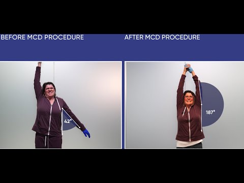 Ophthalmologist’s Frozen Shoulder Gone in 2 Days | No Surgery Needed