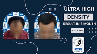 Hair Transplant Result of Grade 5 Patient 4250 Grafts -AHIS Hair Transplant Mysore